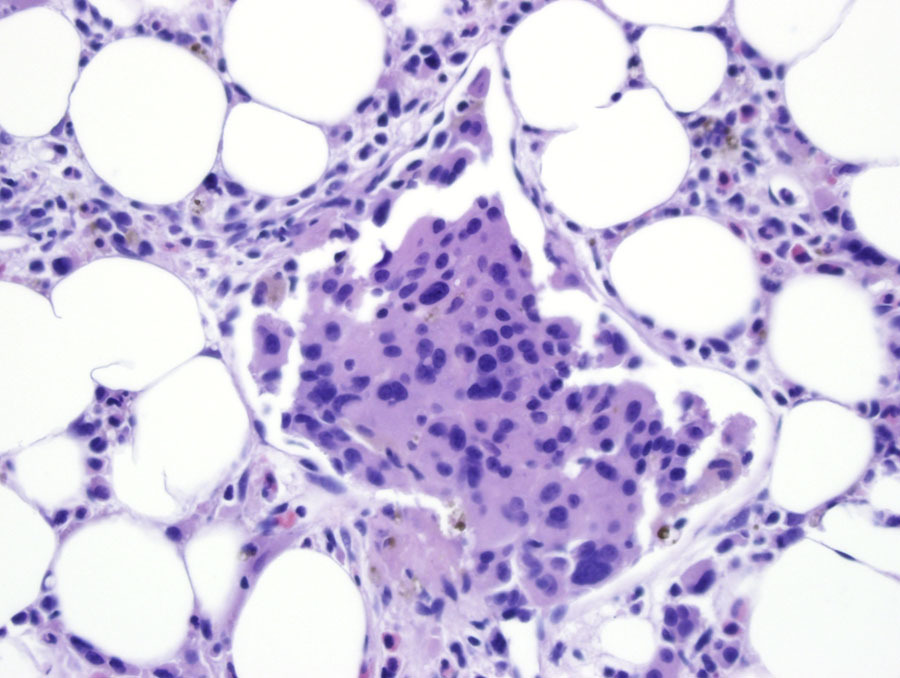 Fig 2B Refract dis BMX intrasinusoidal megakaryocytes 40x